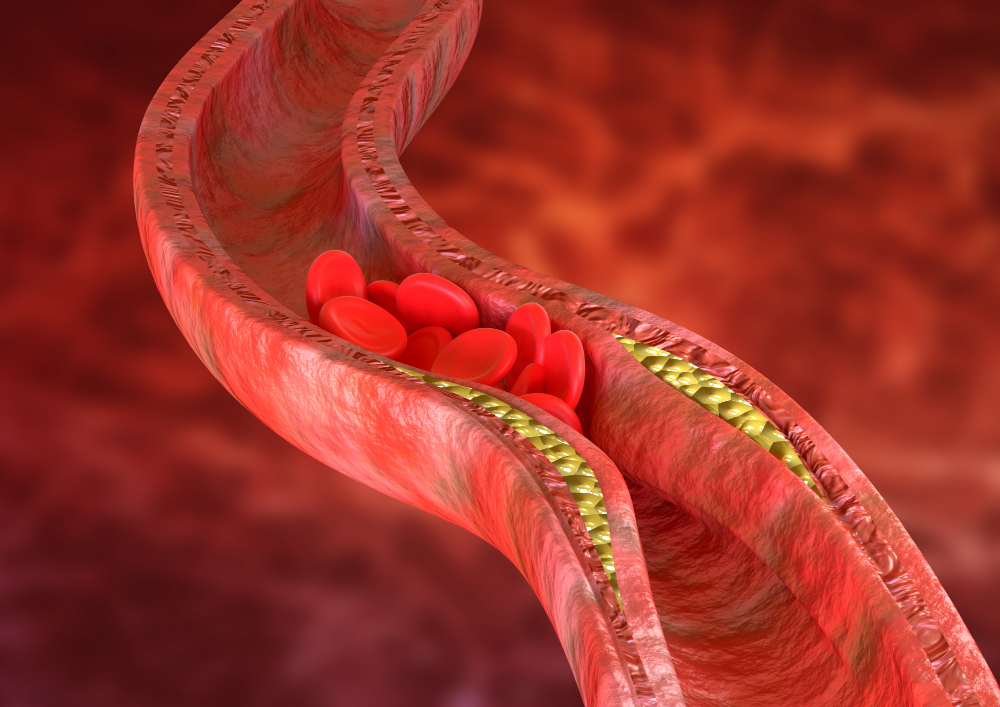 Kaip sumažinti cholesterolio kiekį natūraliai? Mitybos ir gyvenimo būdo patarimai