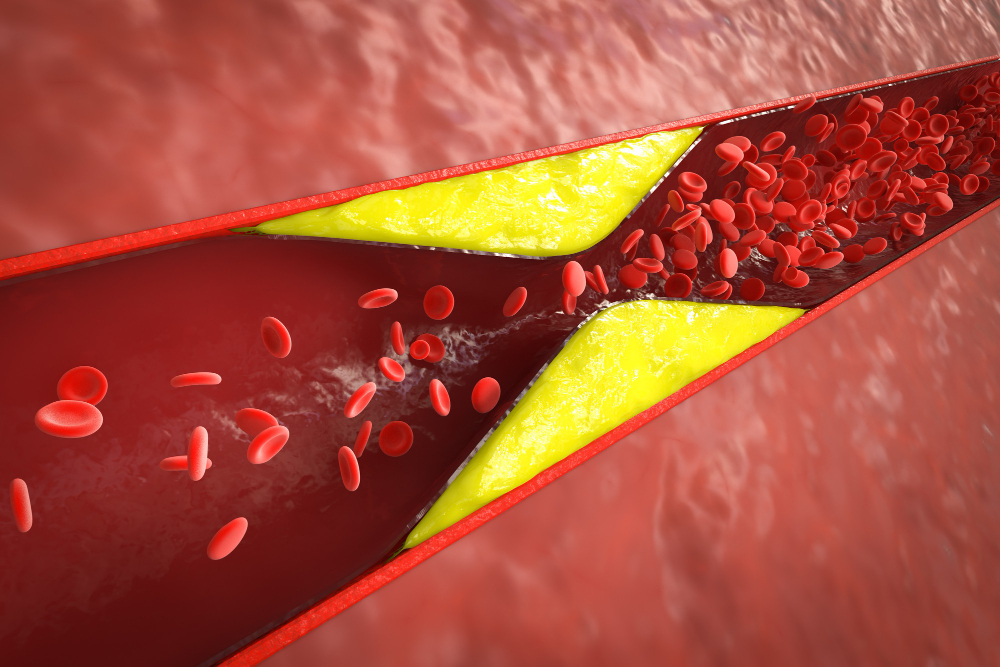 Ką valgyti norint sumažinti cholesterolio kiekį kraujyje? Gydytojų patarimai